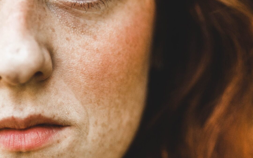 Managing Menopausal Acne: A Comprehensive Guide
